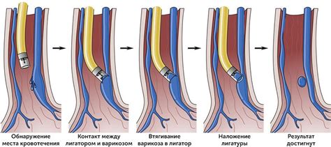 Какие изменения в обычной диете необходимы после лигирования вен пищевода?