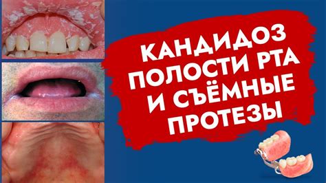 Какие точные ассоциации вызывает наличие глиста в полости рта?