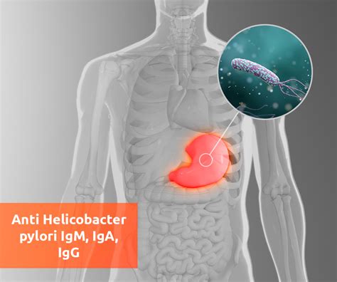 Каковы последствия положительного Igm helicobacter pylori?