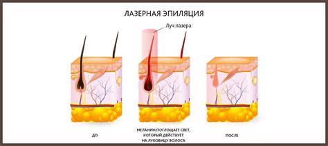 Какое воздействие имеют электроэпиляция и лазерная эпиляция на волоски?