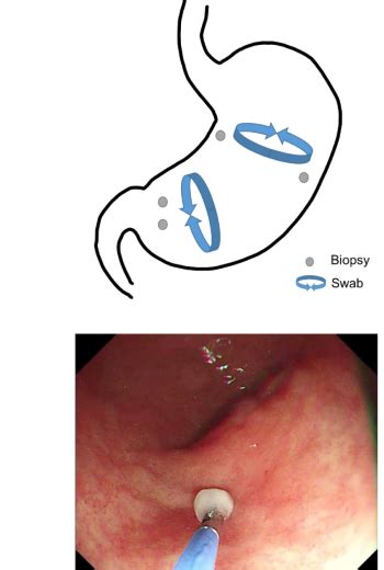 Как восстановить верность диагноза Helicobacter pylori?