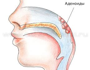 Как диагностировать аденоиды