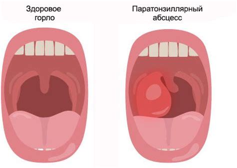 Как лечить абсцесс горла?