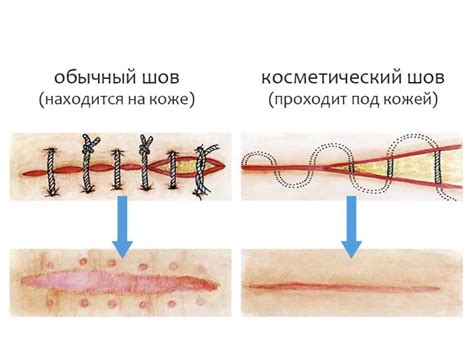 Как определить, когда можно снимать швы после операции на колене?