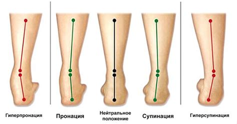 Как определить свой тип пронации