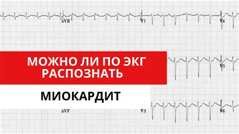 Как отличить ЭКГ от эхоКГ?