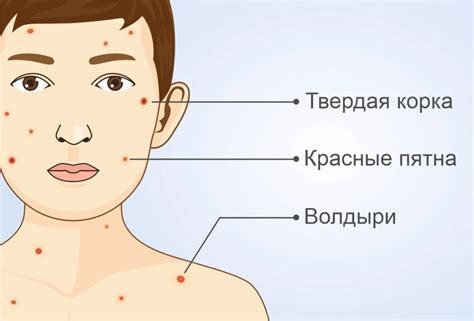 Как предотвратить распространение ветрянки?