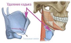 Как происходит процесс удаления кадыка у мужчин