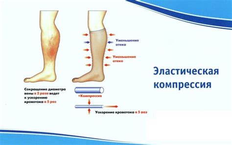 Как работает эластическая компрессия?