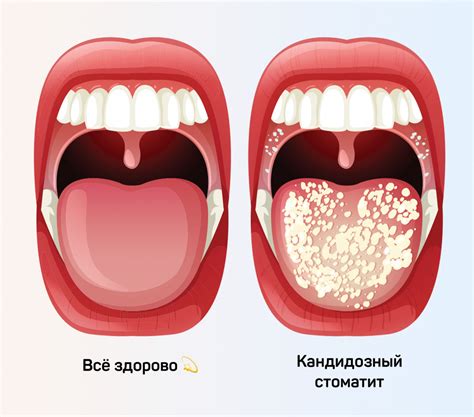 Кандидозный стоматит
