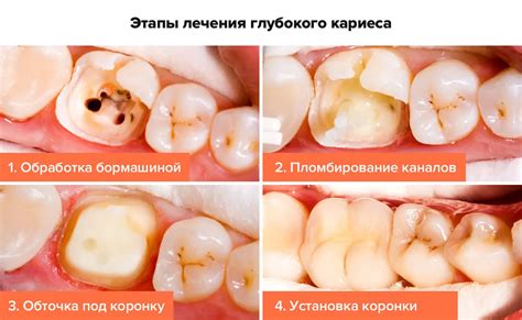 Кариес внутри зуба: предостережение или предвещание?