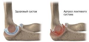 Когда обратиться к врачу при болях в локтях