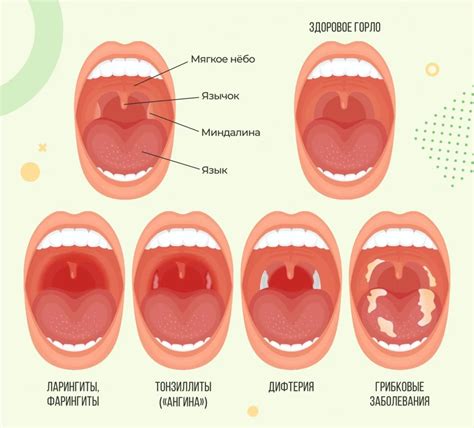 Когда обратиться к врачу при гнойном воспалении горла у ребенка