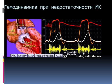 Компликации недостаточности мк 1 степени