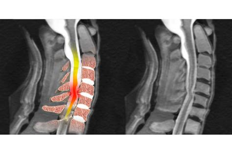 Компрессионная миелопатия: что это и каковы ее причины?