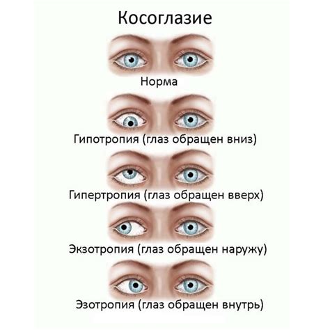 Косоглазие у другого: интерпретация значений сновидения