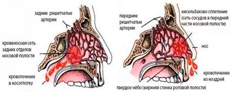 Кровотечение из носа: причины и методы остановки