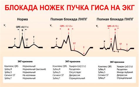 Лечение блокады левой ножки пучка Гиса