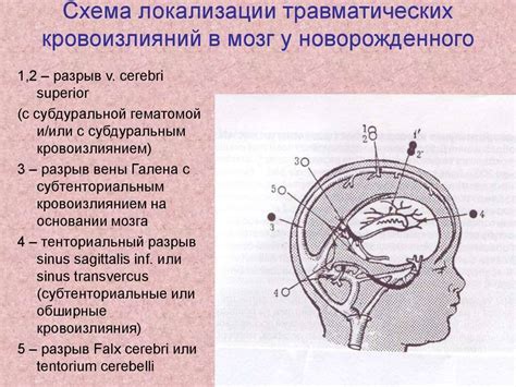 Лечение кровоизлияния в мозг у новорожденных