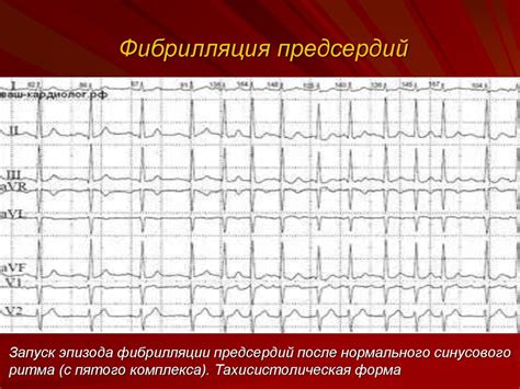 Лечение постоянной формы фибрилляции предсердий