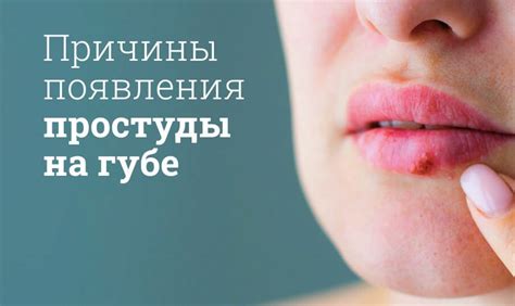 Лечение простуды на губе: эффективные методы и средства