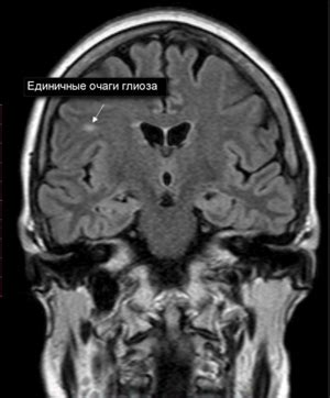 Лечение супратенториальных очагов глиоза