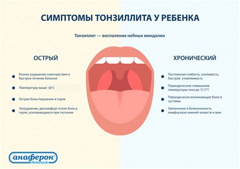 Лечение тонзиллита у ребенка