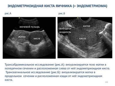 Лечение увеличенного правого яичника