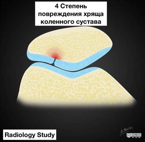 Лечение хондромаляции надколенника 4 степени