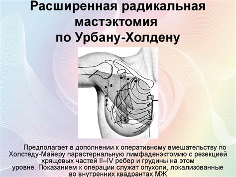 Мастэктомия: важная процедура для лечения рака молочной железы