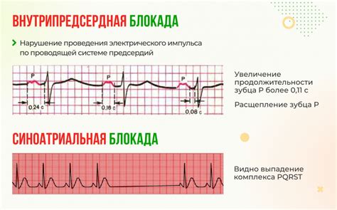 Межпредсердная блокада 1 степени