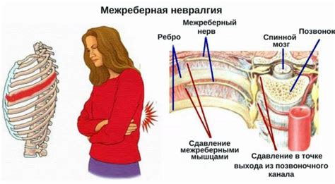 Межреберная невралгия и ее отражение в области паха