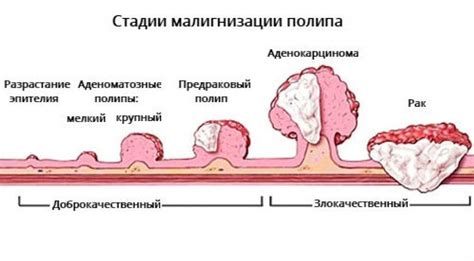 Методика тотальной биопсии полипов