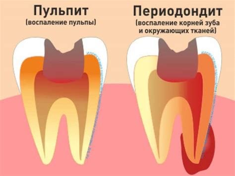 Методы и советы по предотвращению и лечению поражения зубов зубным налетом и их восстановлению