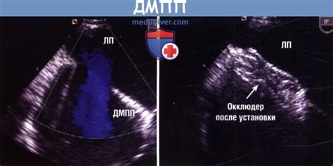 Методы лечения ВПС ДМПП