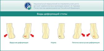 Методы лечения вальгусной деформации стоп у детей