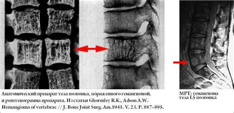 Методы лечения гемангиомы в теле с7 позвонка