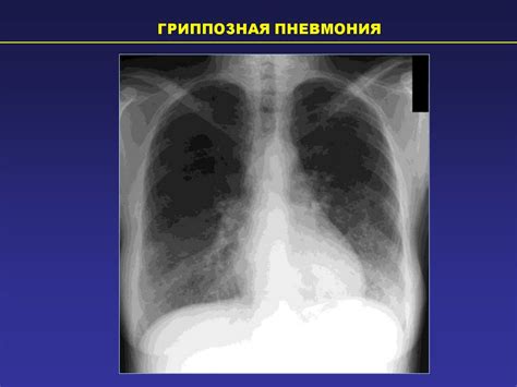 Методы лечения гравитационных изменений в легких