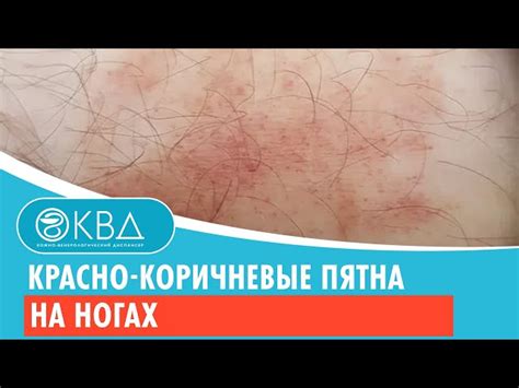 Методы лечения и профилактика красно-коричневых пятен на ноге