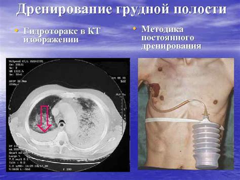 Методы лечения серозной жидкости в плевральной полости