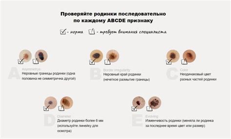 Множественные родинки - что они значат?