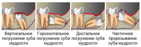 Неправильное подрезание корней