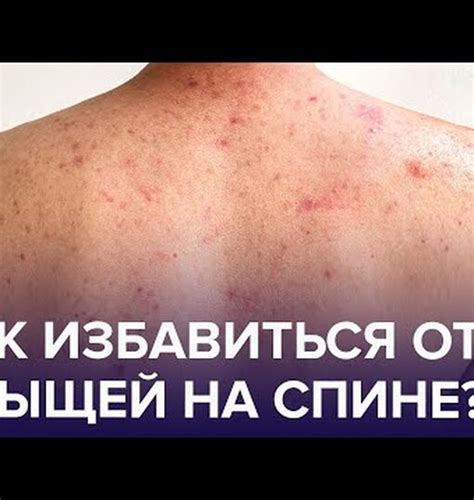 Неприятные высыпания на спине и плечах: как их избежать