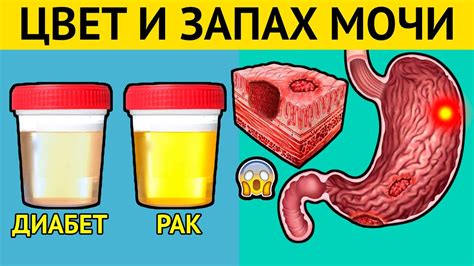 Неприятный запах мочи: почему возникает?