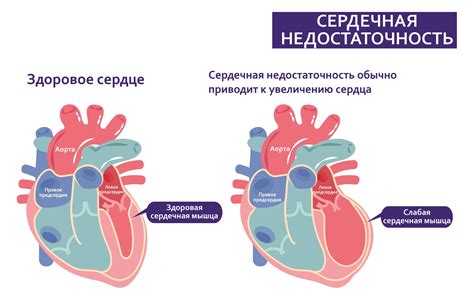 Одышка при сердечной недостаточности