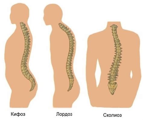 Означение искривления позвоночника: причины и виды