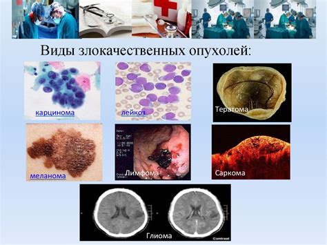 Онкологические заболевания почки