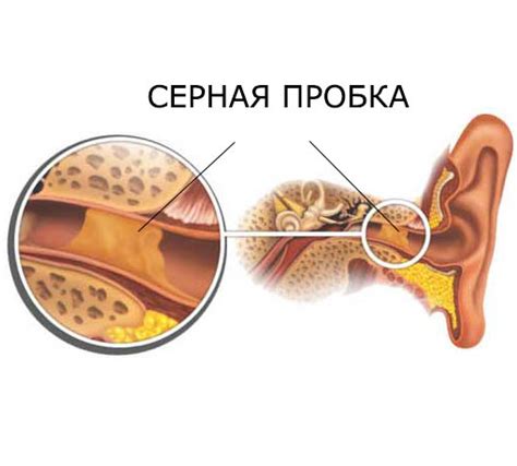 Опасность съедения серы из ушей