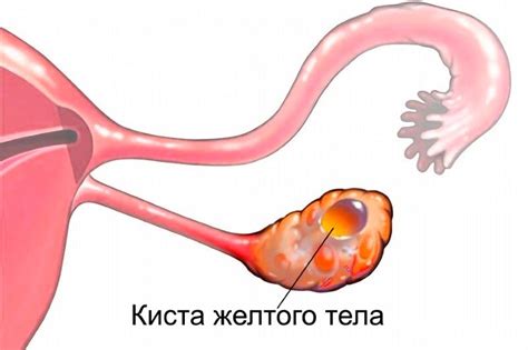 Описание и симптомы ОРАДС 2 яичника