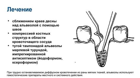 Осложнения, возникающие при неправильном удалении крючка: